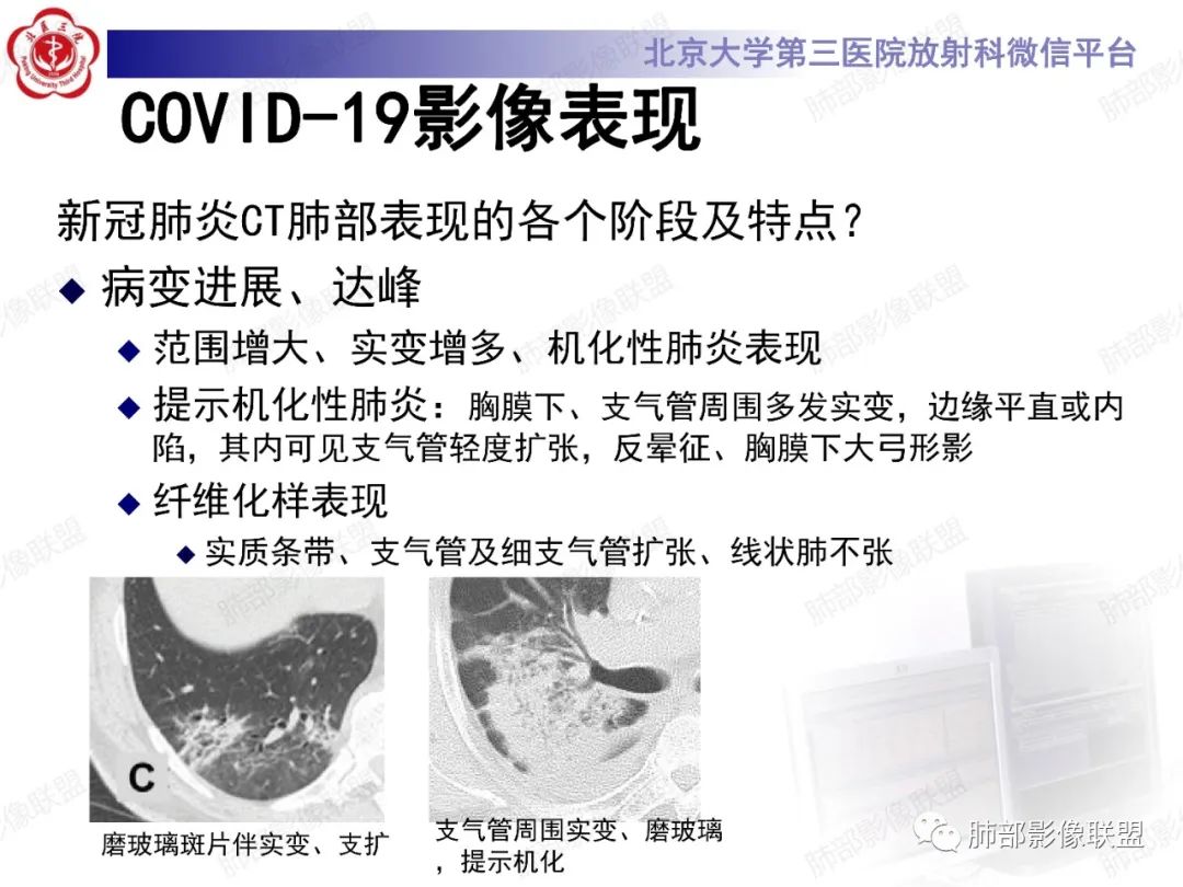 影像PPT - 【PPT】新冠肺炎CT影像表现-16