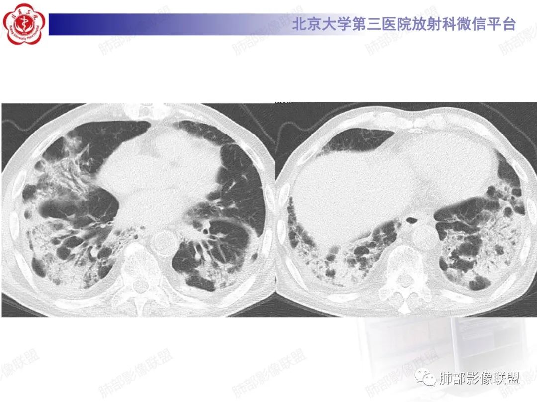 影像PPT - 【PPT】新冠肺炎CT影像表现-18
