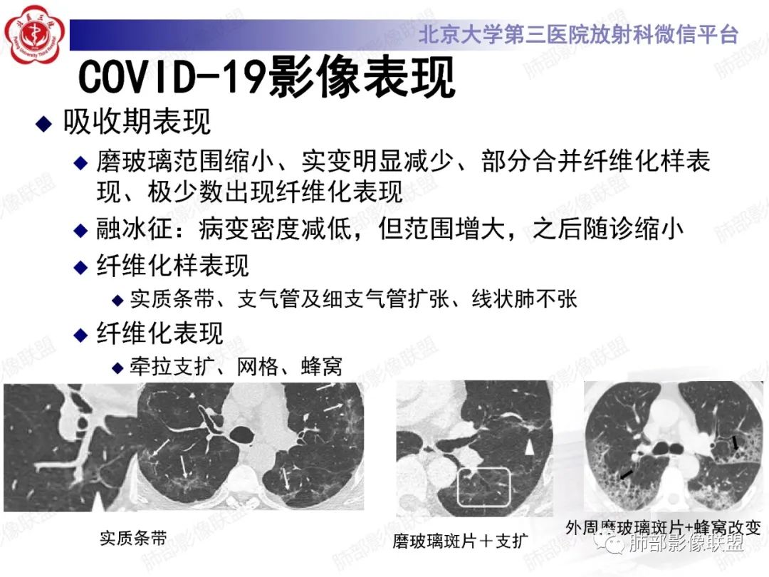 影像PPT - 【PPT】新冠肺炎CT影像表现-19
