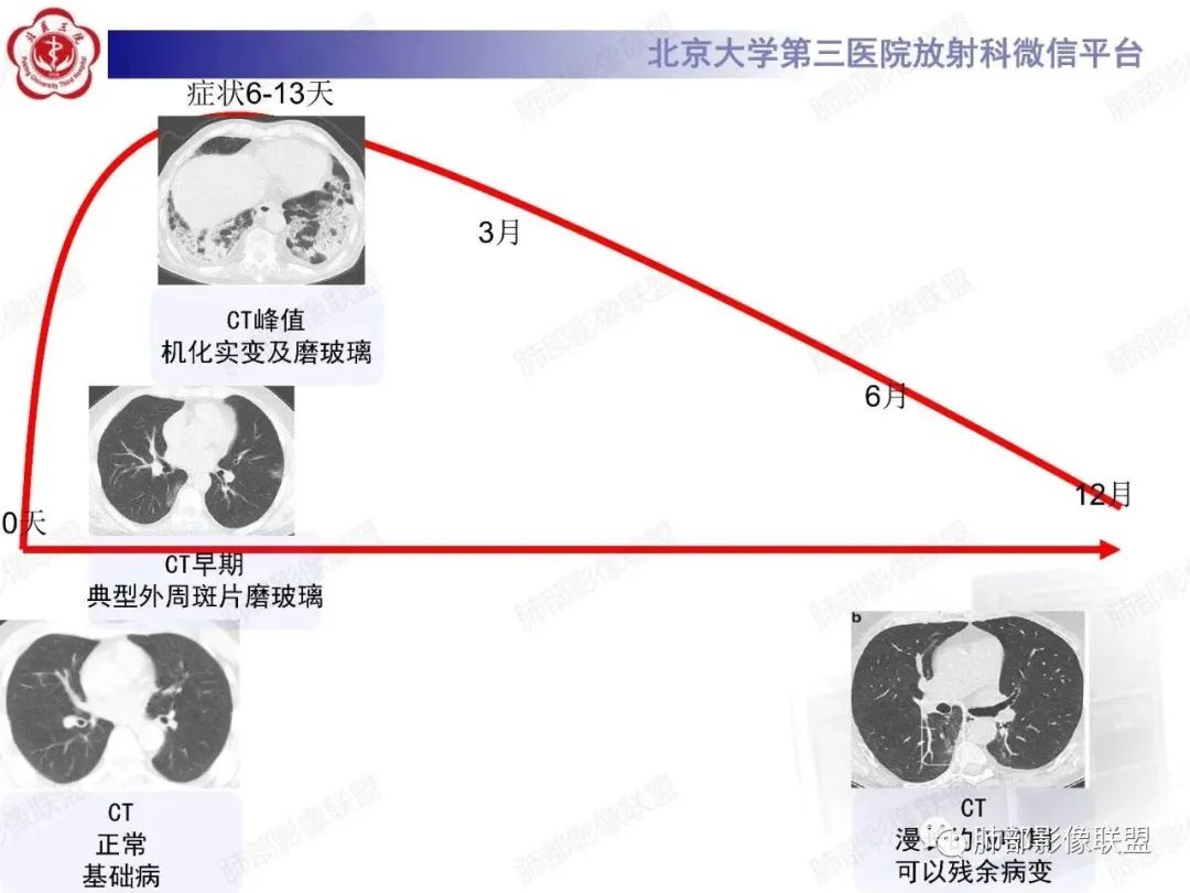 影像PPT - 【PPT】新冠肺炎CT影像表现-23