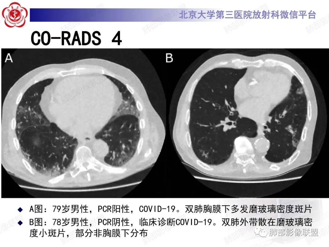影像PPT - 【PPT】新冠肺炎CT影像表现-38