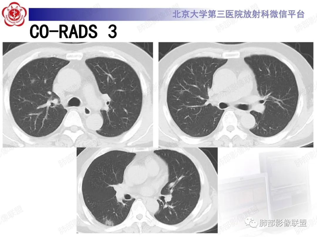 影像PPT - 【PPT】新冠肺炎CT影像表现-40