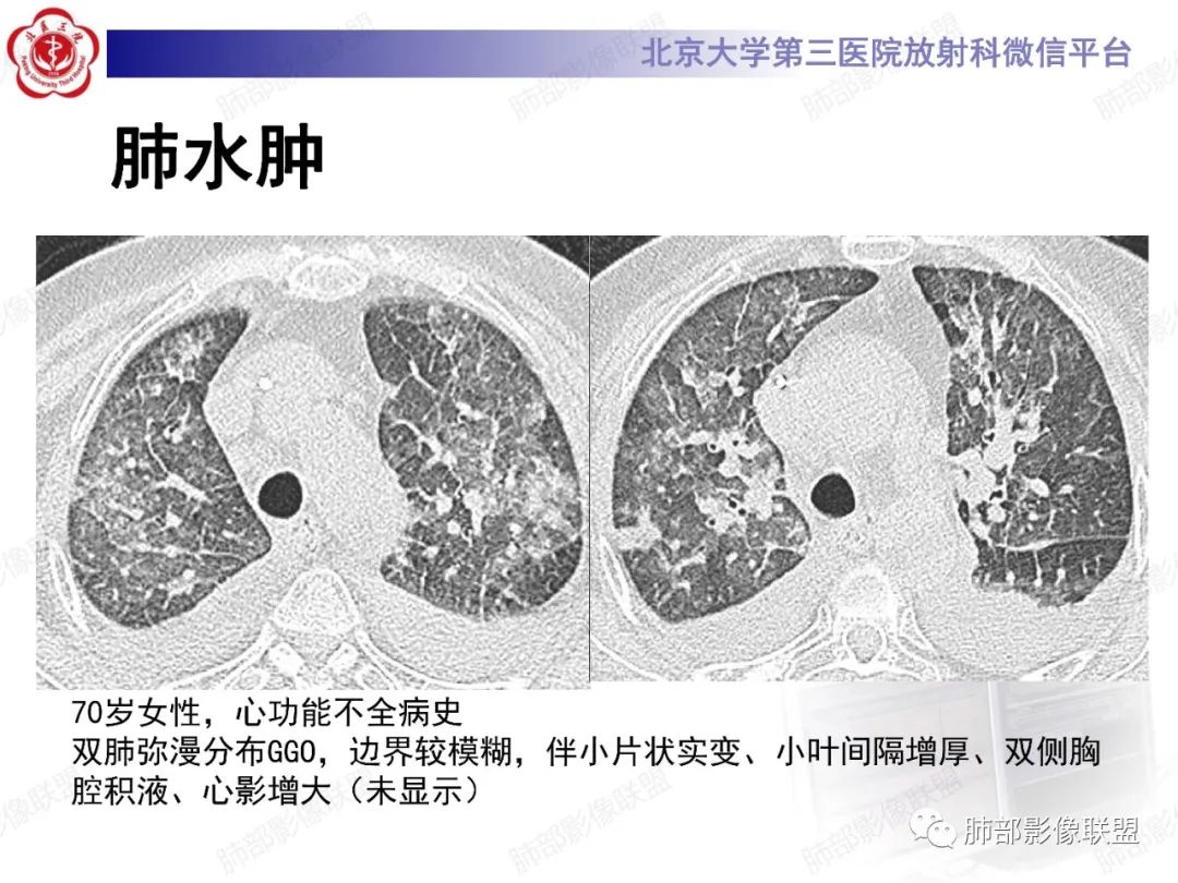 影像PPT - 【PPT】新冠肺炎CT影像表现-43