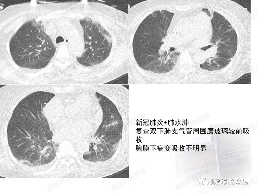 影像PPT - 【PPT】新冠肺炎CT影像表现-44