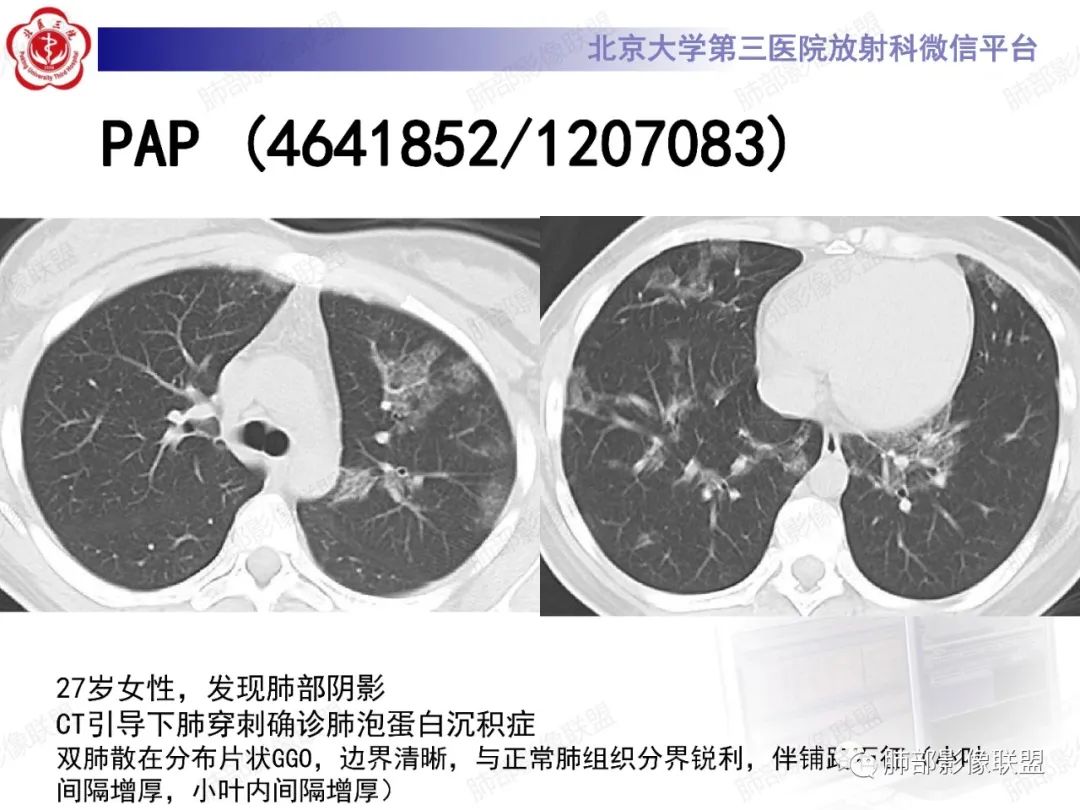 影像PPT - 【PPT】新冠肺炎CT影像表现-45