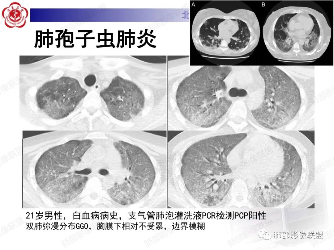 影像PPT - 【PPT】新冠肺炎CT影像表现-46