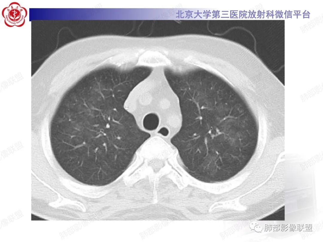 影像PPT - 【PPT】新冠肺炎CT影像表现-47