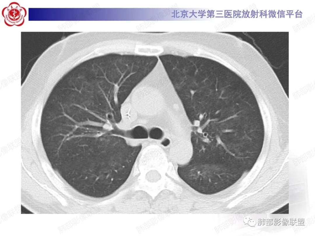 影像PPT - 【PPT】新冠肺炎CT影像表现-48