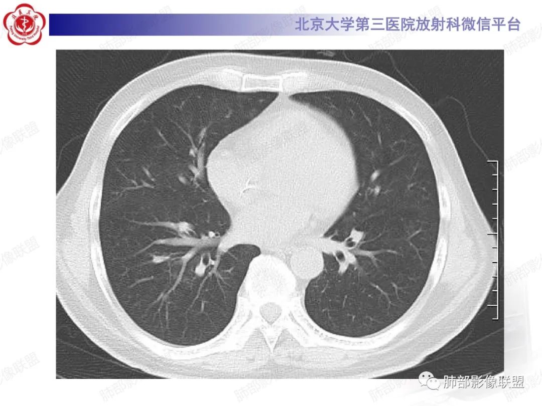 影像PPT - 【PPT】新冠肺炎CT影像表现-49