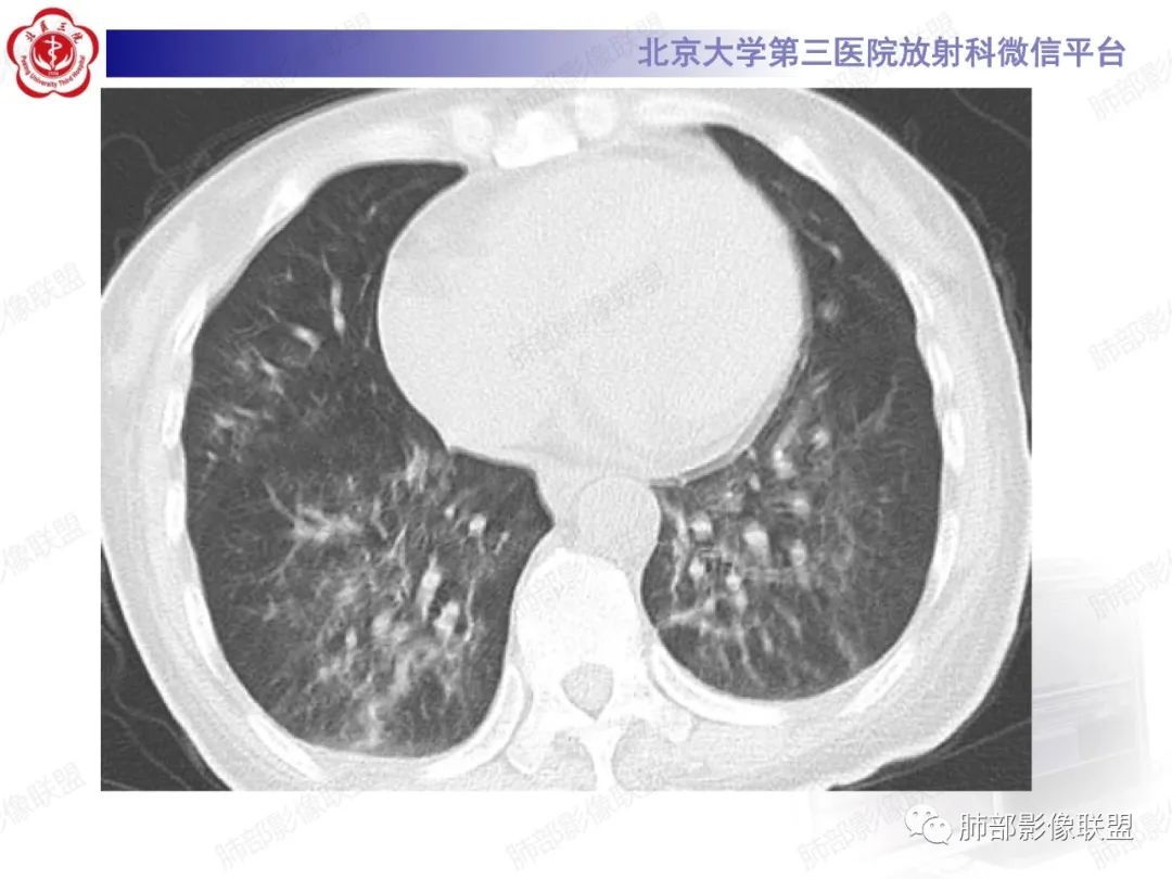 影像PPT - 【PPT】新冠肺炎CT影像表现-51