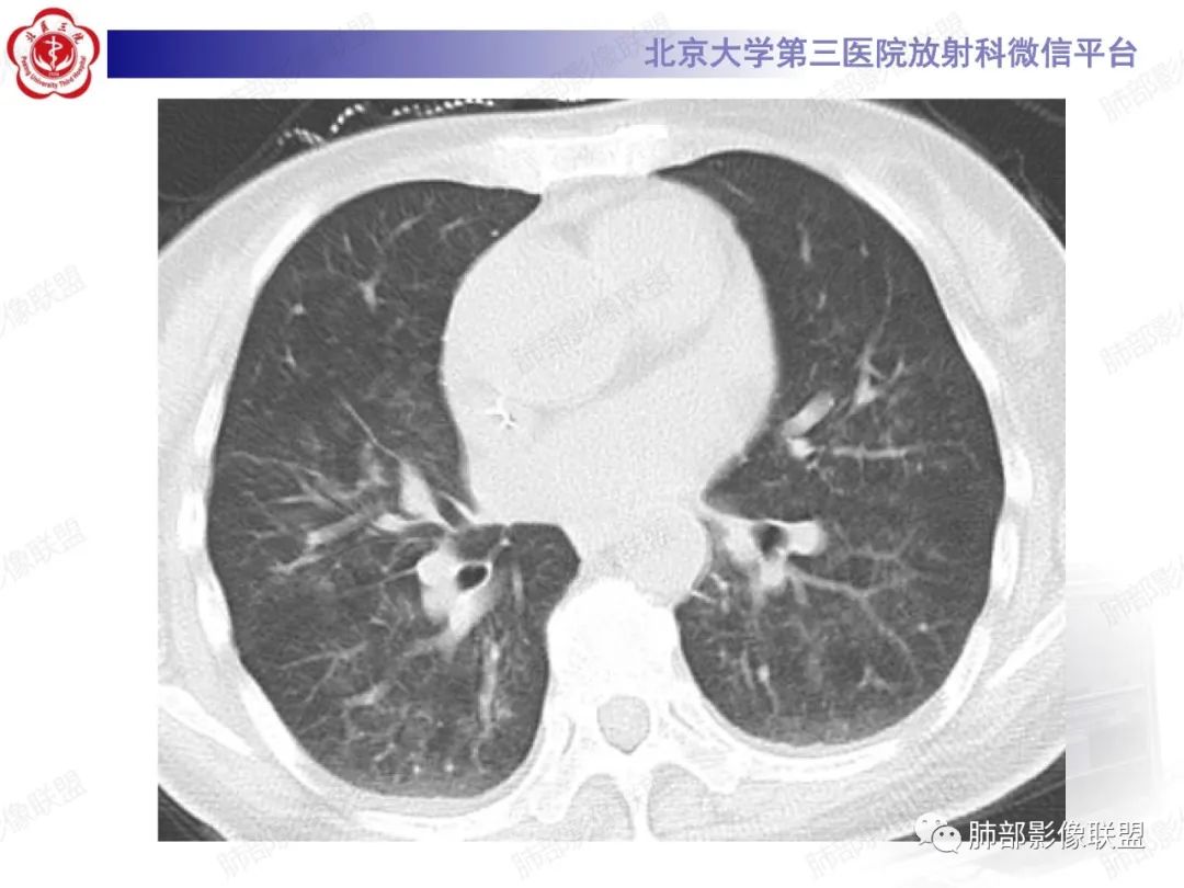 影像PPT - 【PPT】新冠肺炎CT影像表现-50