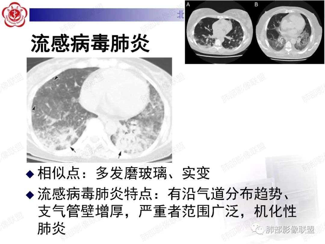 影像PPT - 【PPT】新冠肺炎CT影像表现-53