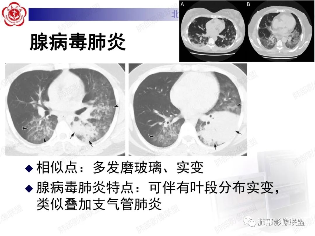 影像PPT - 【PPT】新冠肺炎CT影像表现-54