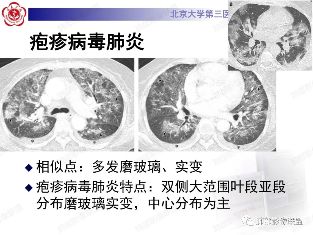 影像PPT - 【PPT】新冠肺炎CT影像表现-55