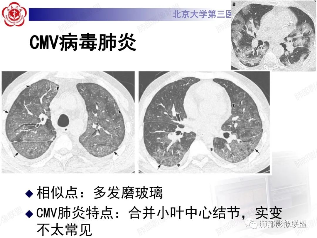 影像PPT - 【PPT】新冠肺炎CT影像表现-56