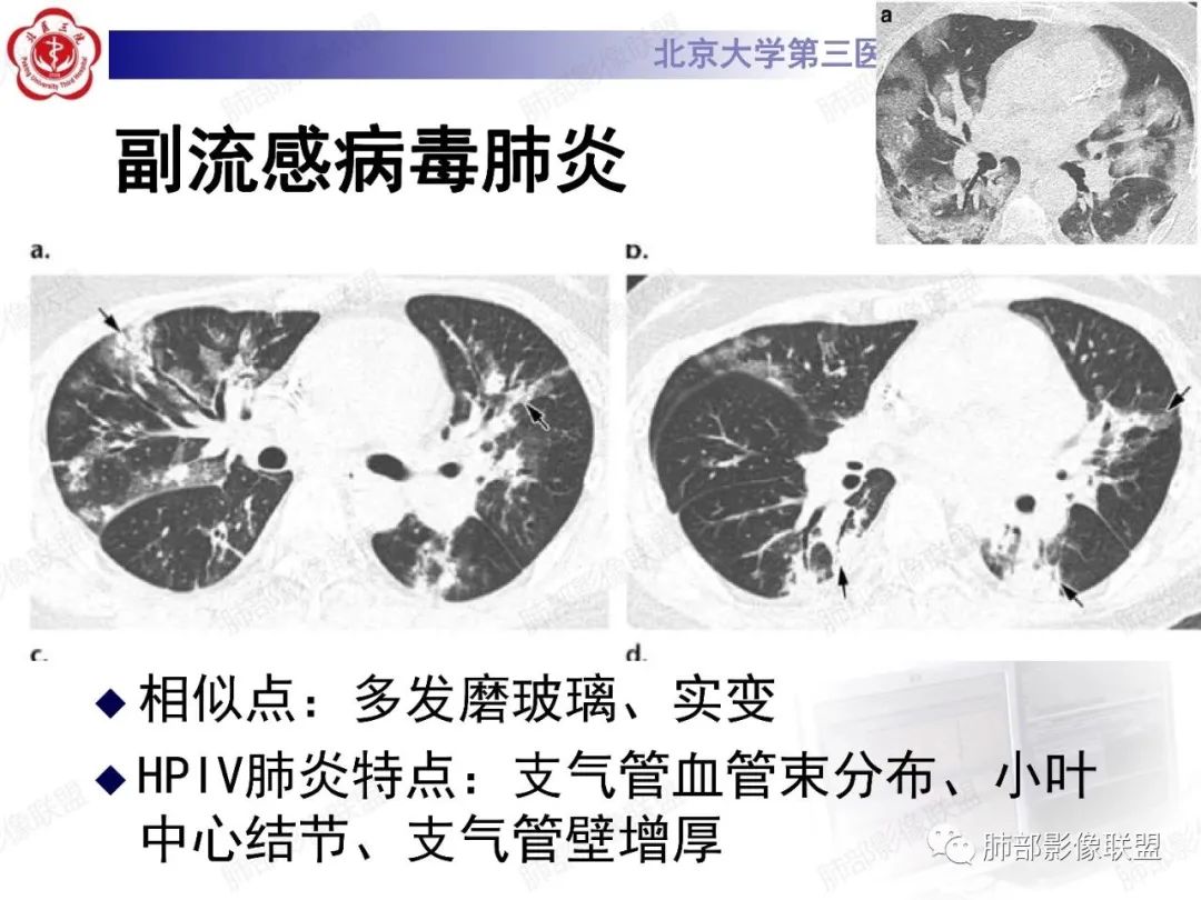 影像PPT - 【PPT】新冠肺炎CT影像表现-57