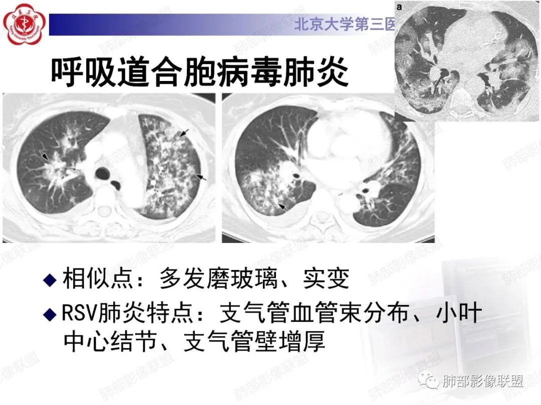 影像PPT - 【PPT】新冠肺炎CT影像表现-58
