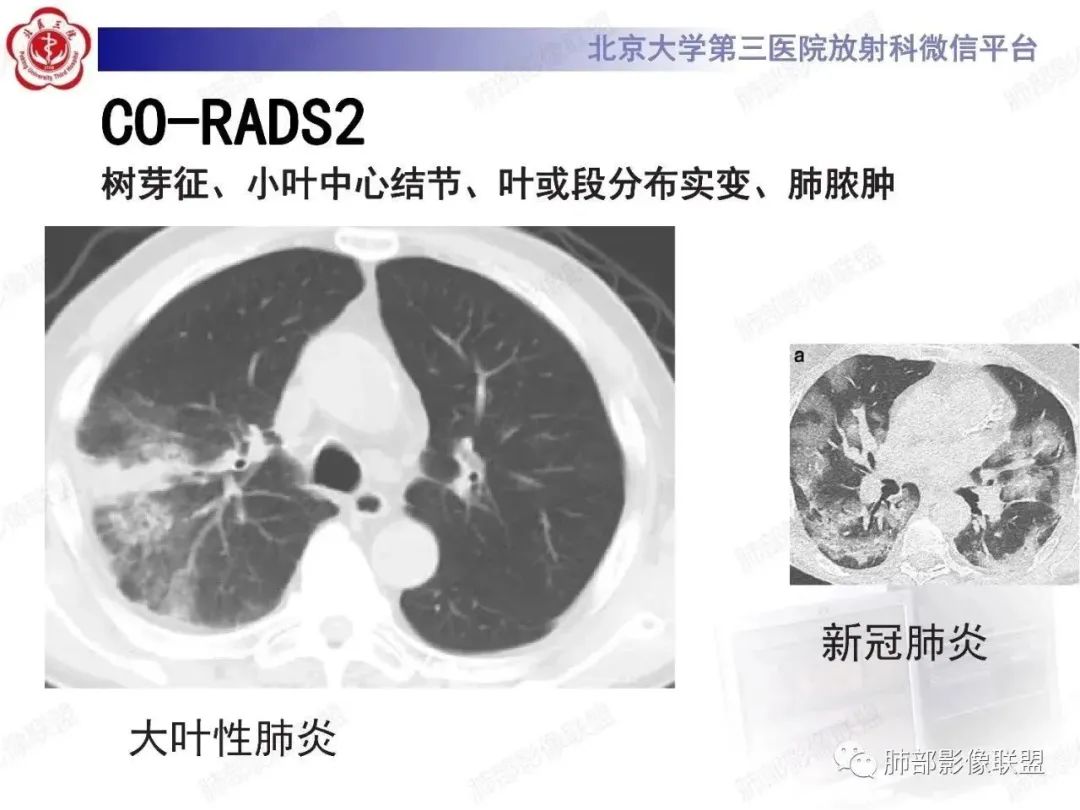 影像PPT - 【PPT】新冠肺炎CT影像表现-60