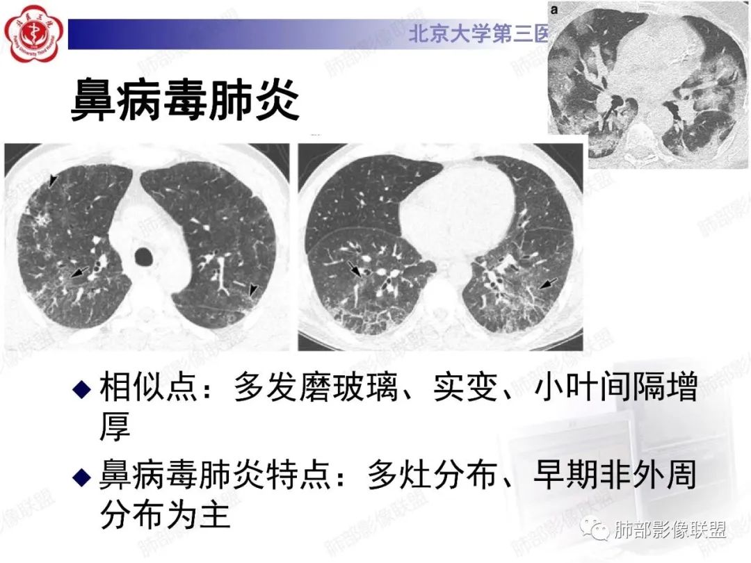 影像PPT - 【PPT】新冠肺炎CT影像表现-59