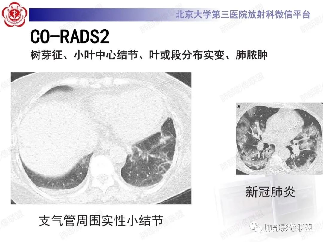 影像PPT - 【PPT】新冠肺炎CT影像表现-61