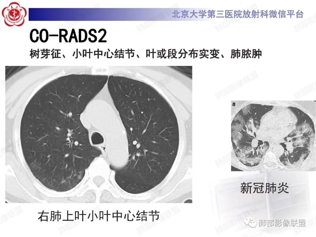 影像PPT - 【PPT】新冠肺炎CT影像表现-62