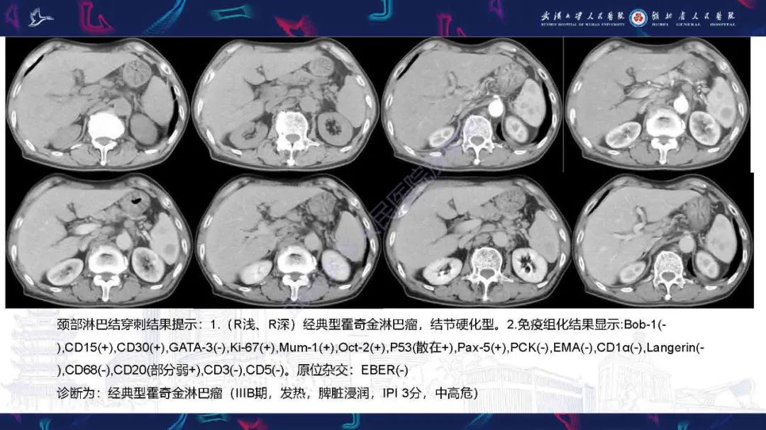 影像PPT - 【PPT】成人脾脏非创伤性病变影像诊断-6