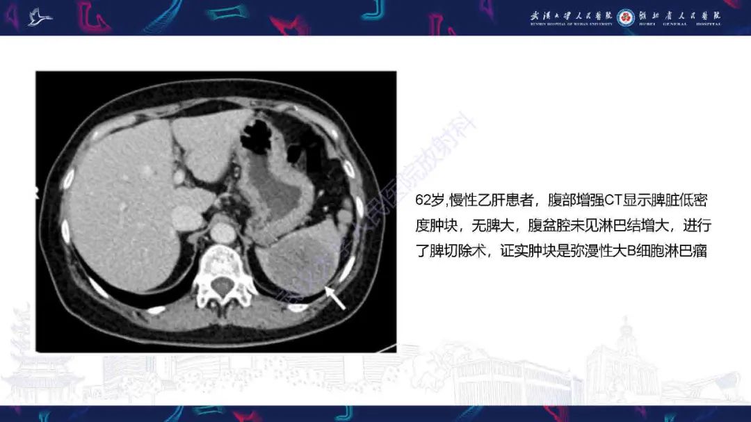 影像PPT - 【PPT】成人脾脏非创伤性病变影像诊断-11