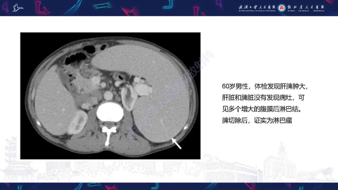 影像PPT - 【PPT】成人脾脏非创伤性病变影像诊断-12