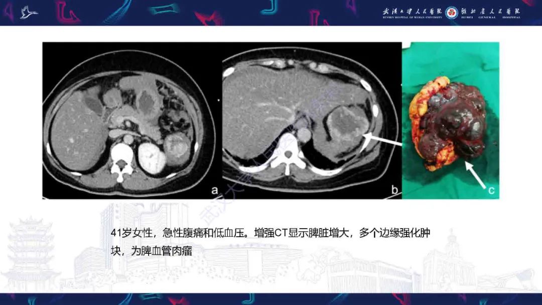 影像PPT - 【PPT】成人脾脏非创伤性病变影像诊断-15