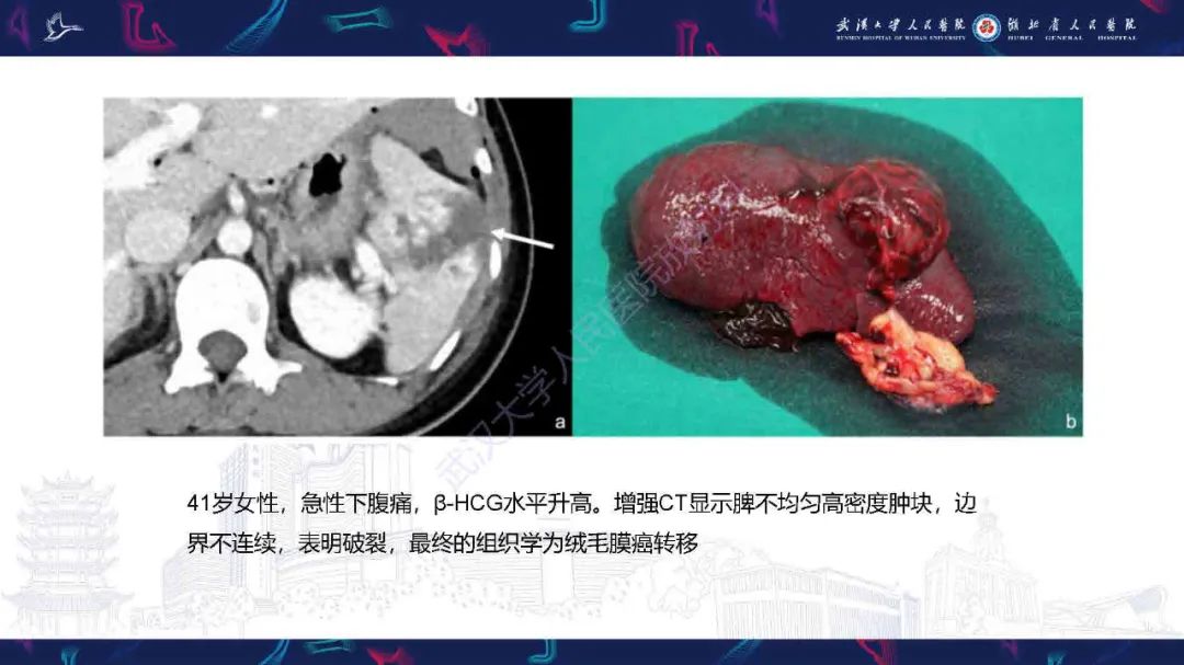 影像PPT - 【PPT】成人脾脏非创伤性病变影像诊断-18