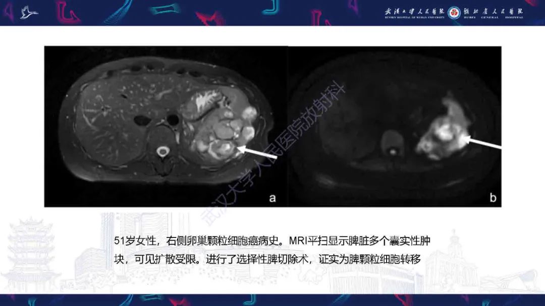 影像PPT - 【PPT】成人脾脏非创伤性病变影像诊断-19