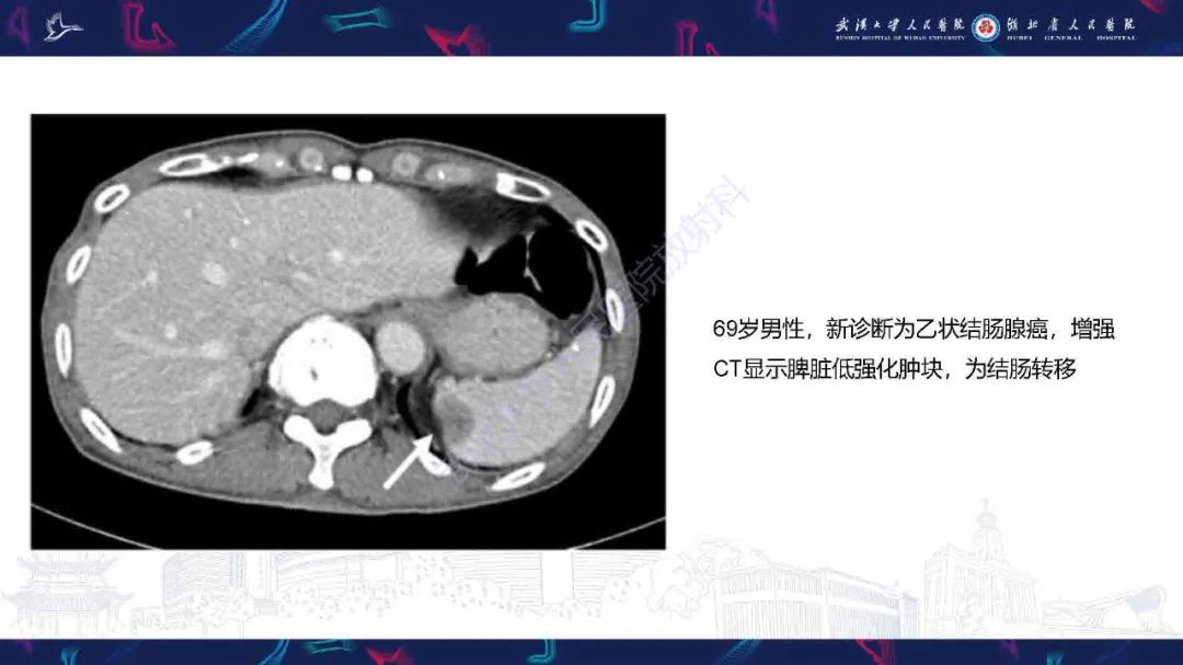 影像PPT - 【PPT】成人脾脏非创伤性病变影像诊断-17