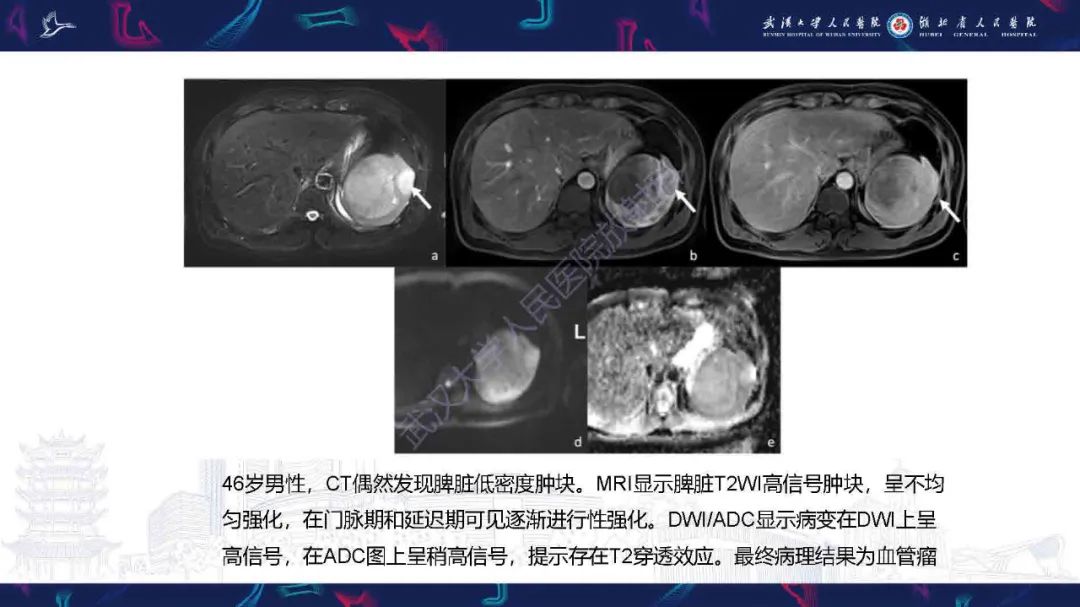 影像PPT - 【PPT】成人脾脏非创伤性病变影像诊断-23