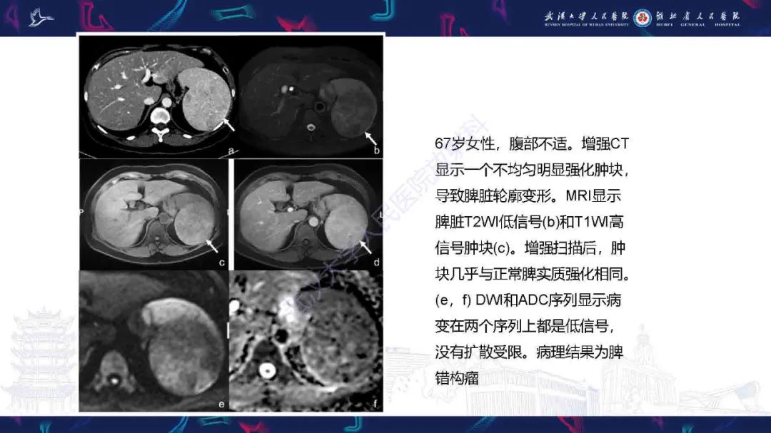 影像PPT - 【PPT】成人脾脏非创伤性病变影像诊断-25
