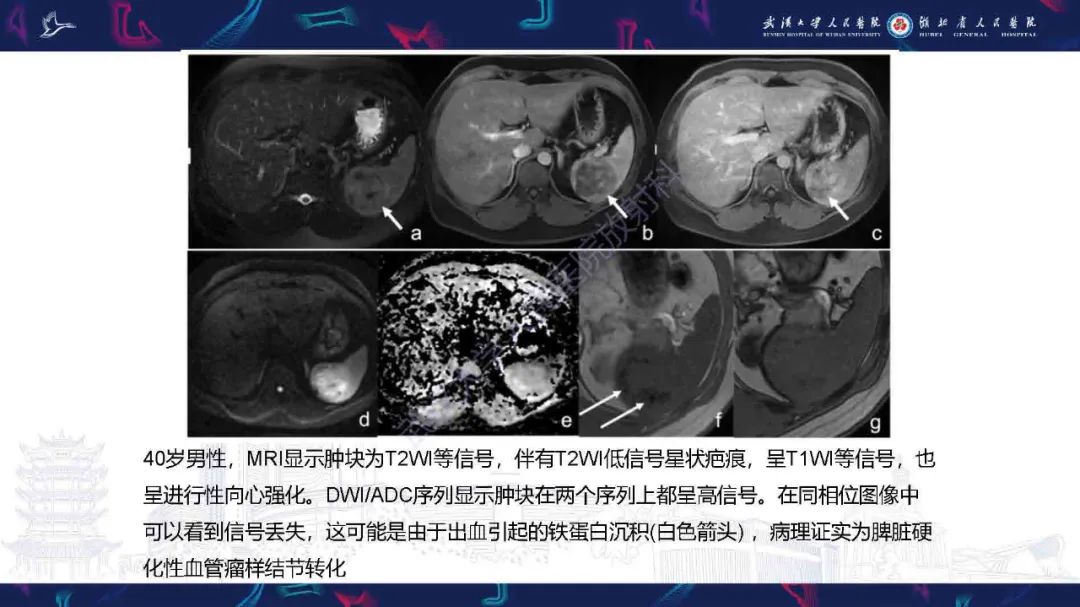 影像PPT - 【PPT】成人脾脏非创伤性病变影像诊断-27