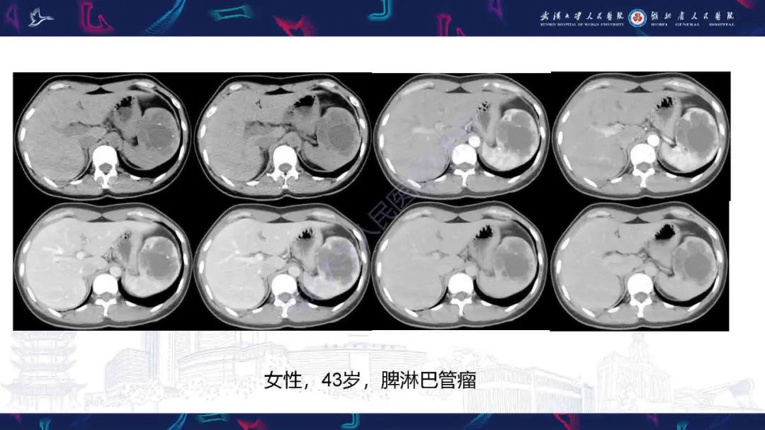 影像PPT - 【PPT】成人脾脏非创伤性病变影像诊断-29
