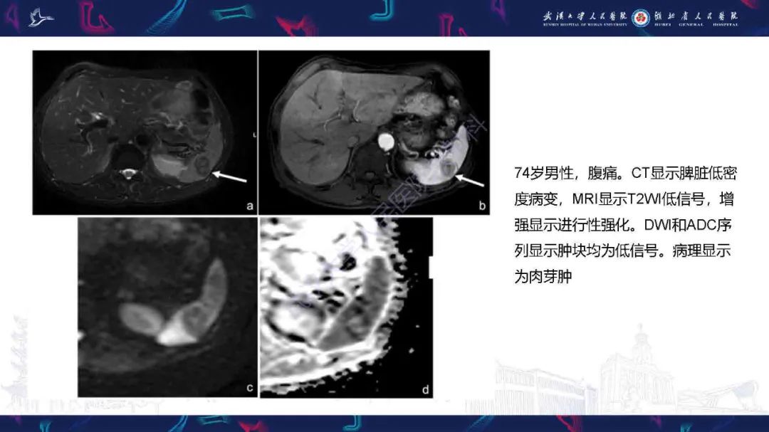 影像PPT - 【PPT】成人脾脏非创伤性病变影像诊断-31