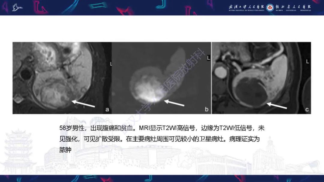 影像PPT - 【PPT】成人脾脏非创伤性病变影像诊断-33