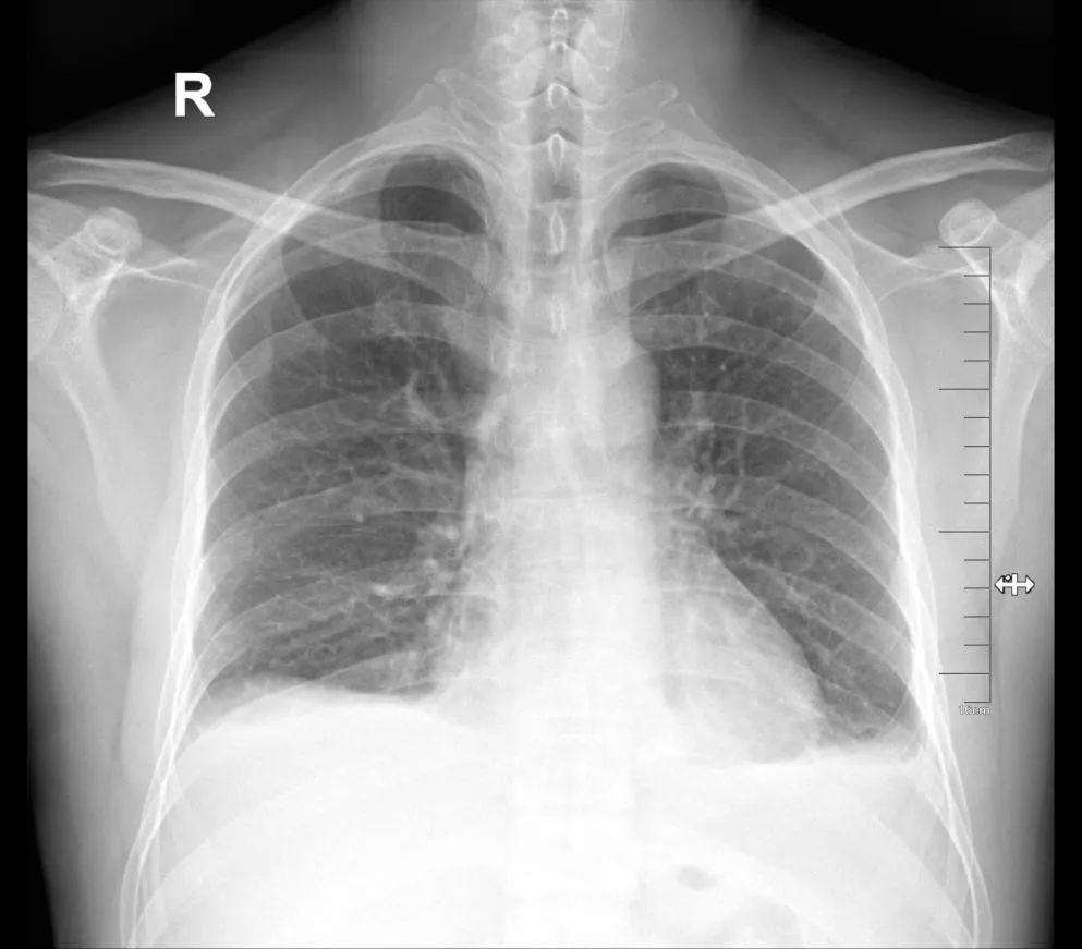 影像PPT - 【病例】结核性腹膜炎2例CT影像特点-3 影像PPT - 【病例】结核性腹膜炎2例CT影像特点-3