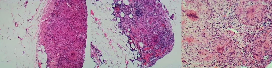 影像PPT - 【病例】结核性腹膜炎2例CT影像特点-7 影像PPT - 【病例】结核性腹膜炎2例CT影像特点-7
