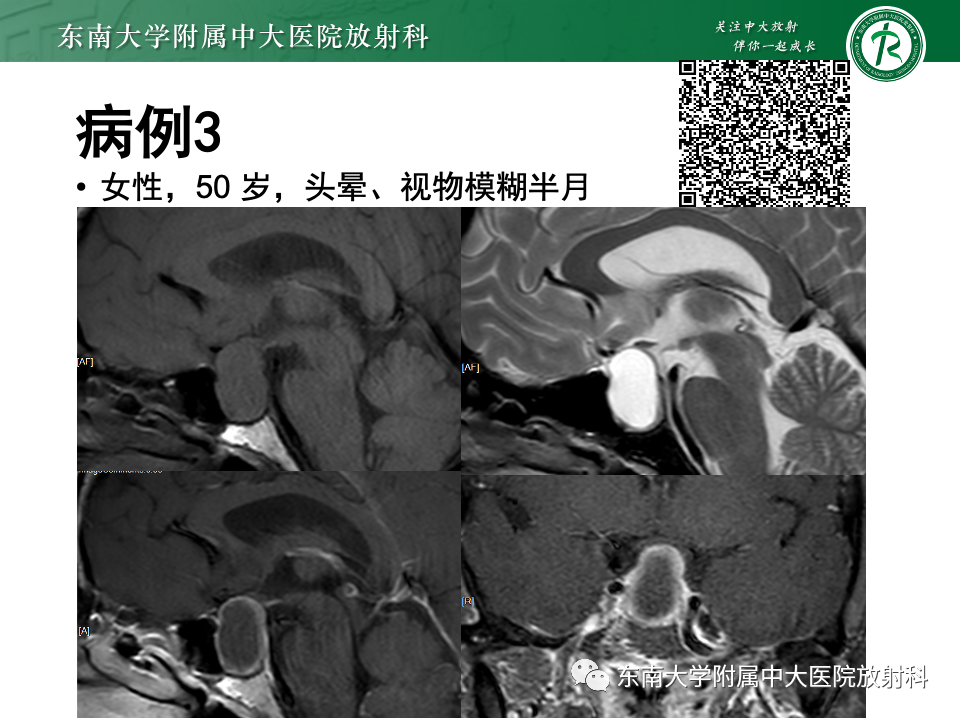 影像PPT - 【PPT】常见鞍内占位影像诊断-3