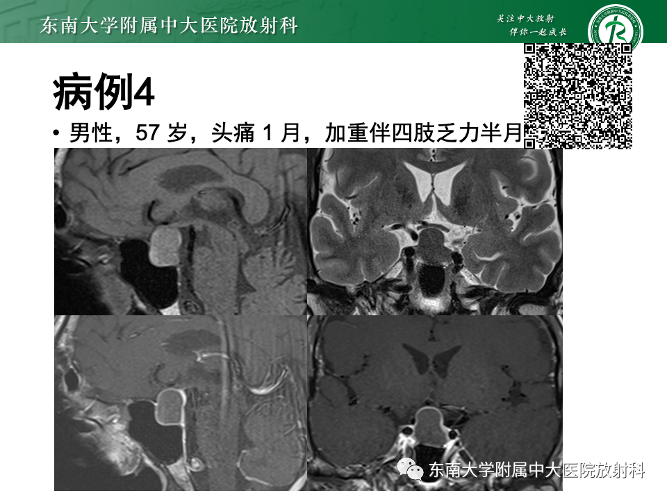 影像PPT - 【PPT】常见鞍内占位影像诊断-4