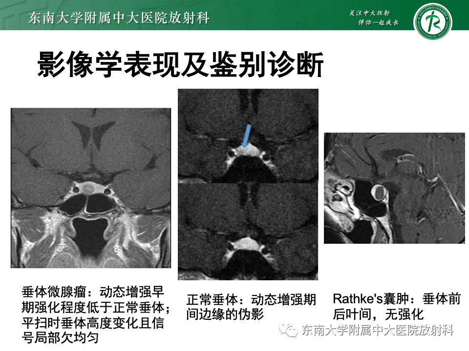 影像PPT - 【PPT】常见鞍内占位影像诊断-13