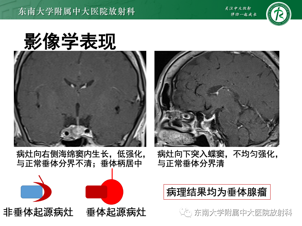 影像PPT - 【PPT】常见鞍内占位影像诊断-14