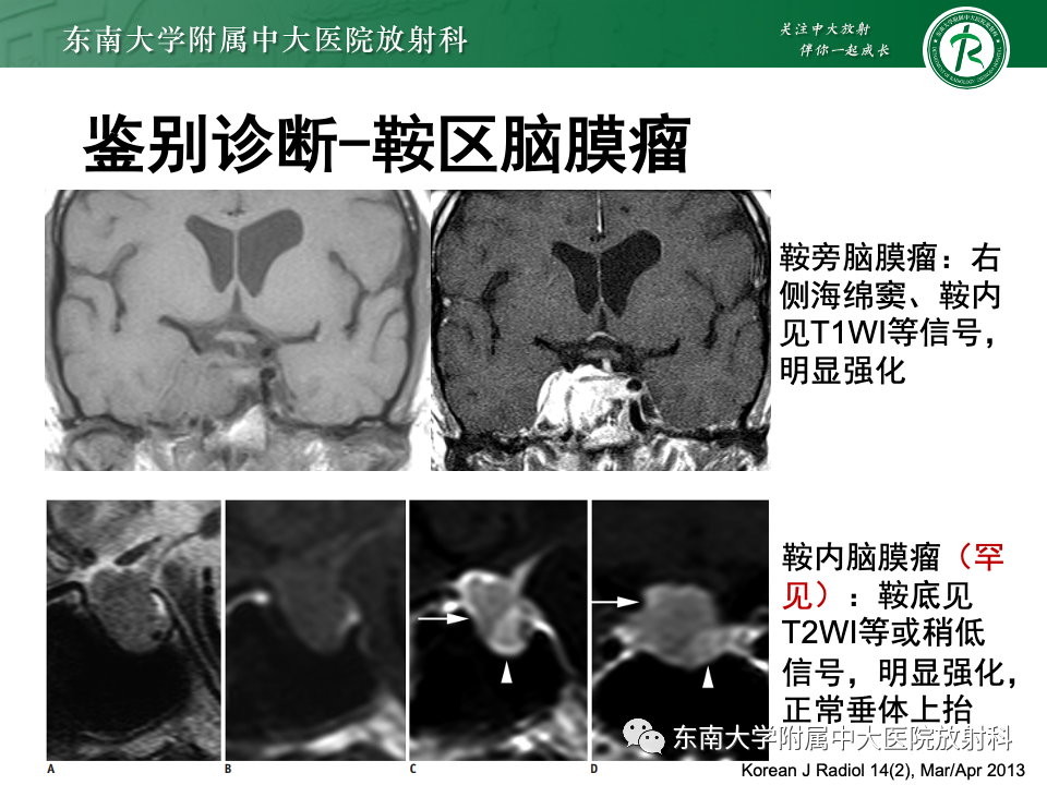 影像PPT - 【PPT】常见鞍内占位影像诊断-16