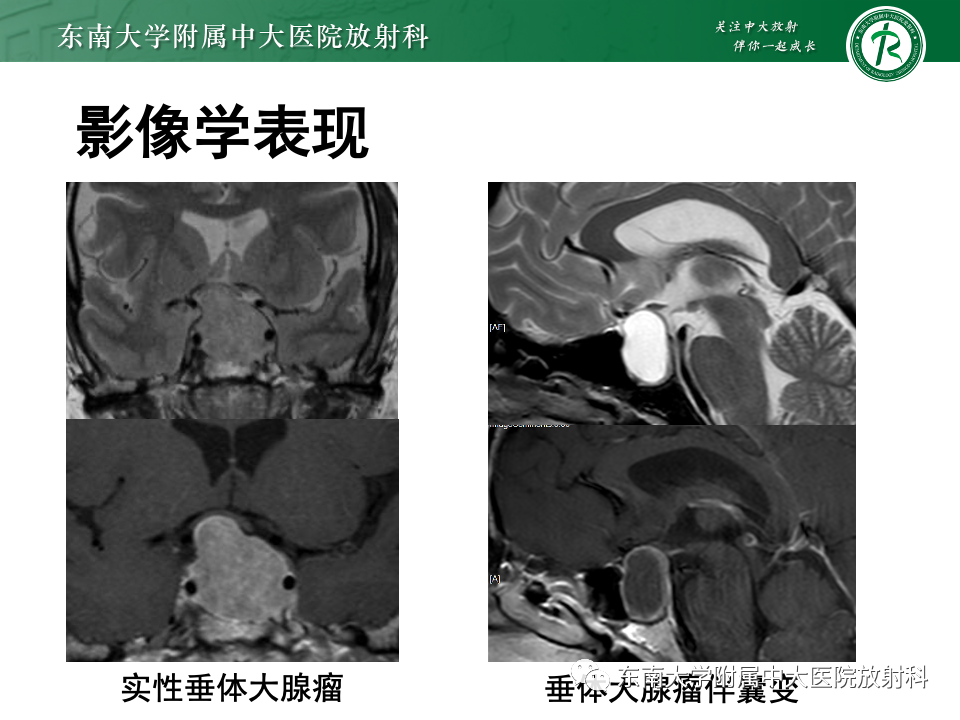 影像PPT - 【PPT】常见鞍内占位影像诊断-17