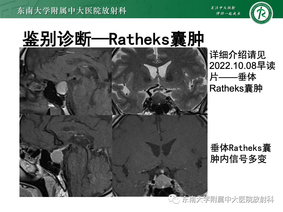 影像PPT - 【PPT】常见鞍内占位影像诊断-18