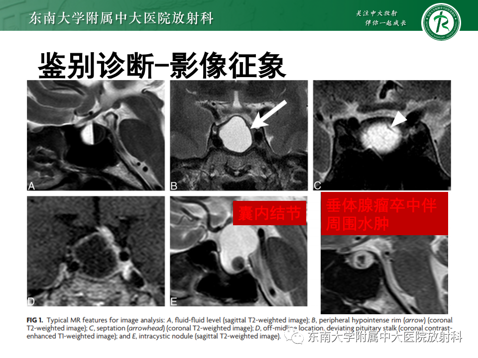 影像PPT - 【PPT】常见鞍内占位影像诊断-19