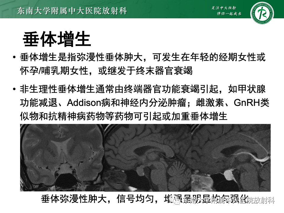 影像PPT - 【PPT】常见鞍内占位影像诊断-21