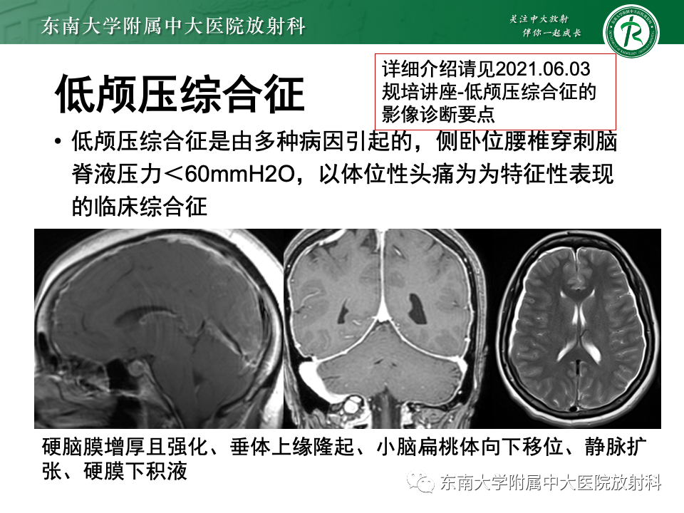 影像PPT - 【PPT】常见鞍内占位影像诊断-22